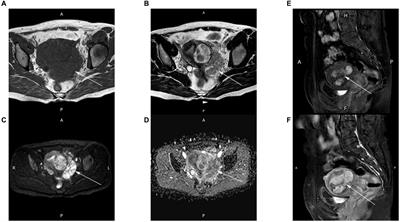 Magnetic resonance imaging findings of intravascular leiomyomatosis of the uterus: a case report